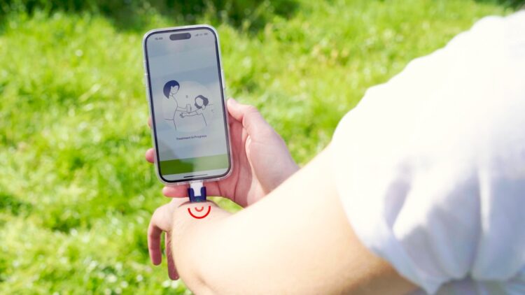 Confirmed by dermatologists - this German mobile phone-connected invention reduces insect itching by 78% in just 10 minutes 1 Confirmed by dermatologists - this German mobile phone-connected invention reduces insect itching by 78% in just 10 minutes