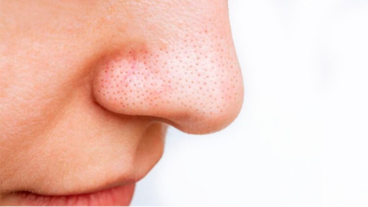 Álex Docampo, dermatologist - “Those blackheads you see on your nose are not acne or dirt, and if you pull them out with strips you only damage your skin” 1 Álex Docampo, dermatologist - “Those blackheads you see on your nose are not acne or dirt, and if you pull them out with strips you only damage your skin”