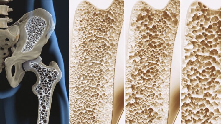 It's official—scientists find the “biological switch” that strengthens bones and could end osteoporosis 1 It's official—scientists find the “biological switch” that strengthens bones and could end osteoporosis