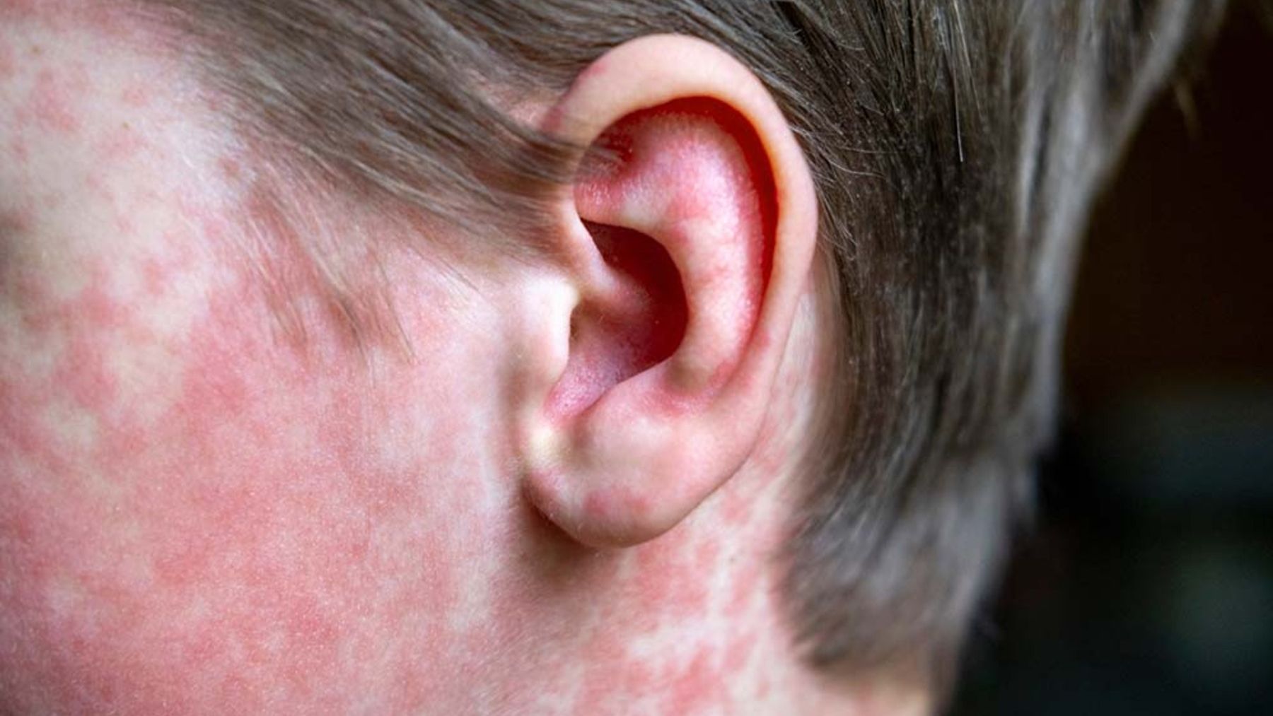 It's official—South Carolina is on health alert after a measles outbreak that has already affected several schools in the state