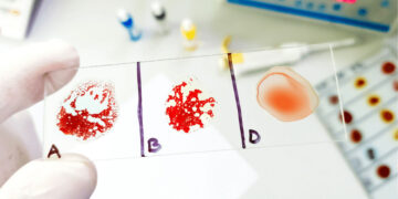 Neither A nor B—this surprising hybrid blood type poses challenges for transfusions and compatibility, according to experts in immunohematology