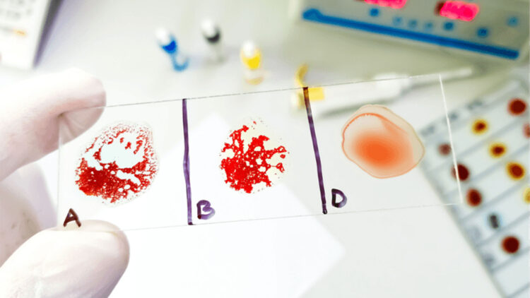 Neither A nor B—this surprising hybrid blood type poses challenges for transfusions and compatibility, according to experts in immunohematology